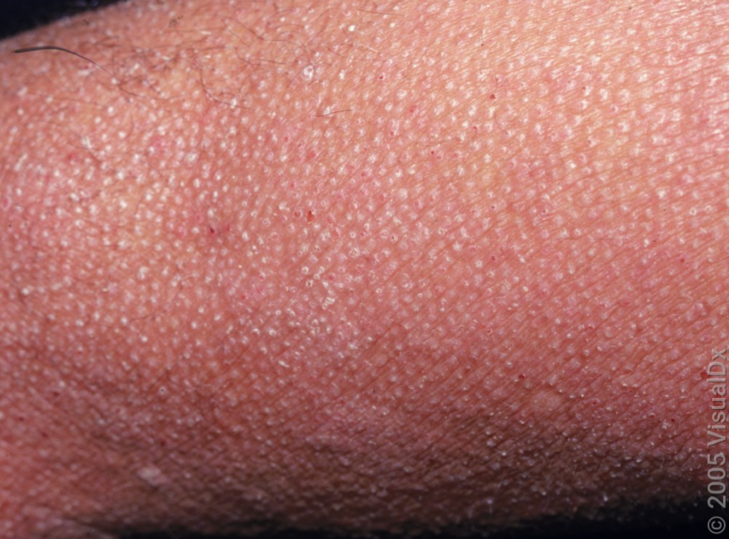 Keratosis Pilaris in Irvine, CA Melissa Shive, MD MPH